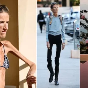 THE WORLD’S THINNEST WOMAN’S BATTLE AGAINST ANOREXIA WILL LEAVE YOU SPEECHLESS!