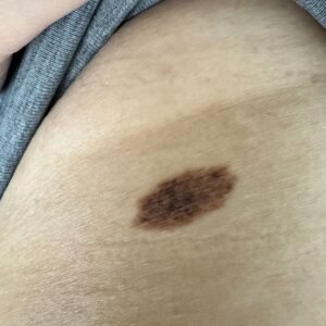 I have this mole that has patchy dark spots on it. What should I do?