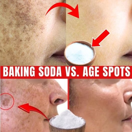 Erasing Age Spots Naturally with Baking Soda