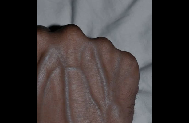 Why Are My Veins Suddenly Bulging and Visible?