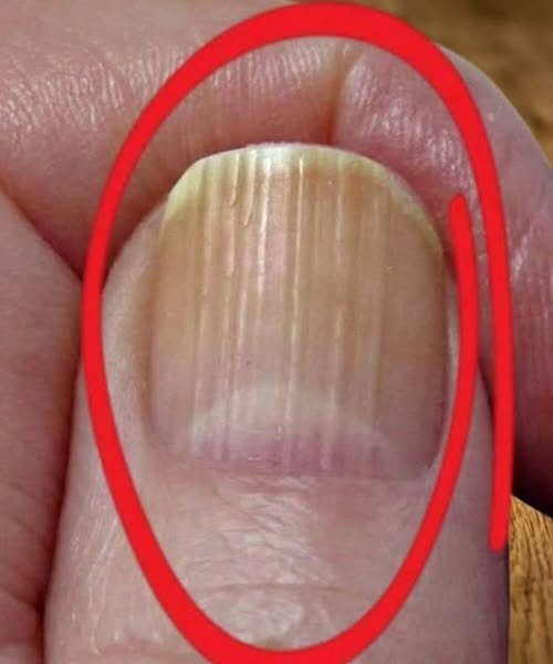 "Close-up of hands showing vertical ridges on fingernails, a common sign of aging."