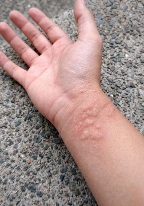 A close-up of a person’s arm with raised, red hives, alongside an epinephrine auto-injector, symbolizing the urgency of recognizing and treating anaphylaxis.